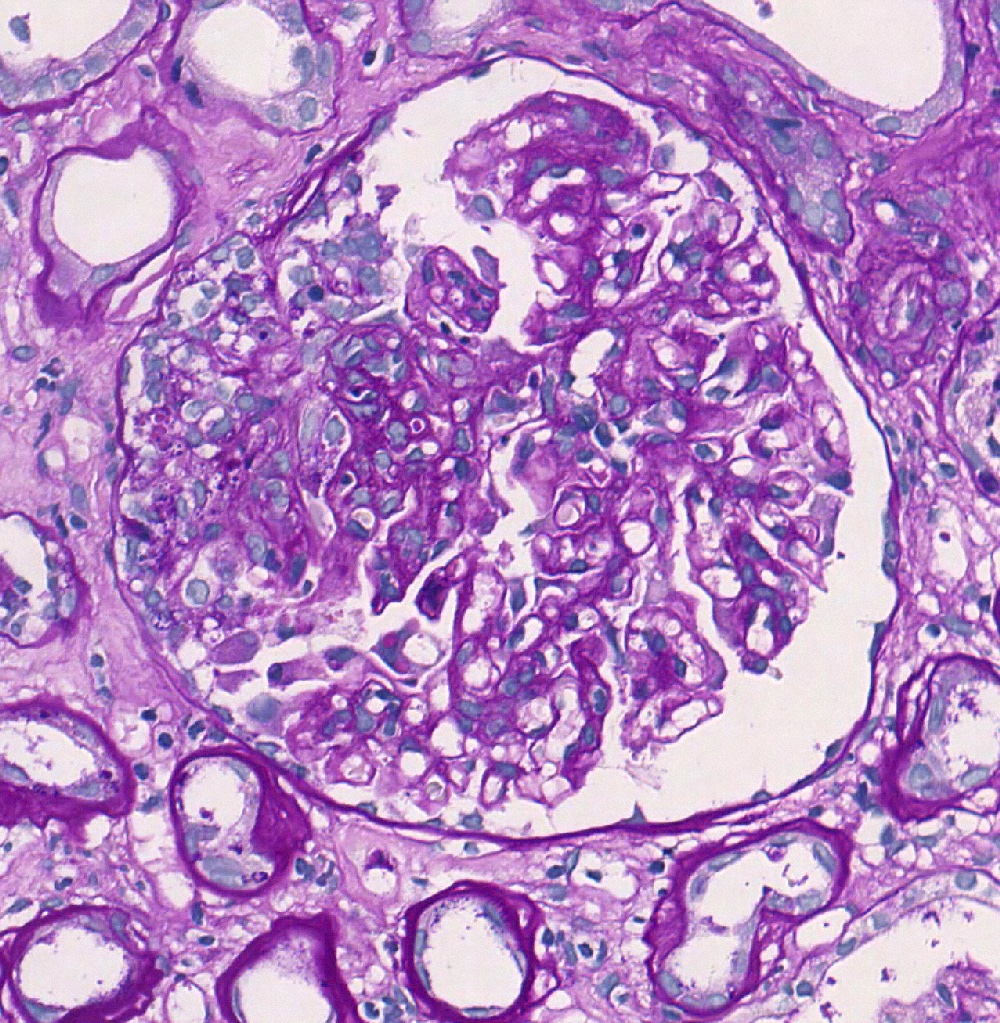 Iga nephropathy